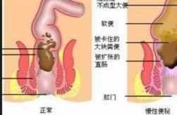 便秘卡住了怎么快速排便